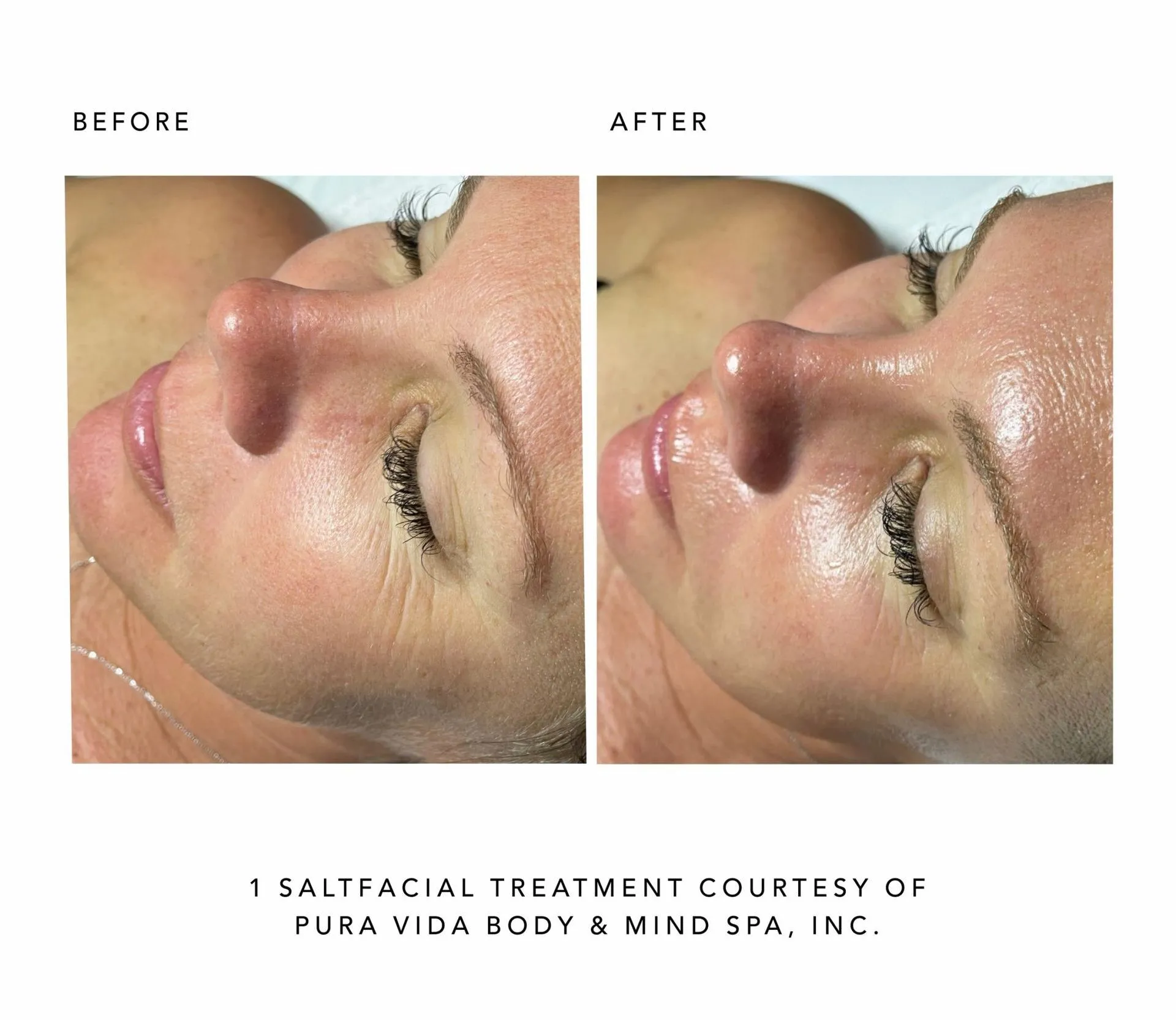 Glow Aesthetics Bar Salt Facial Before After c In Hollidaysburg PA Facials in Hollidaysburg, PA