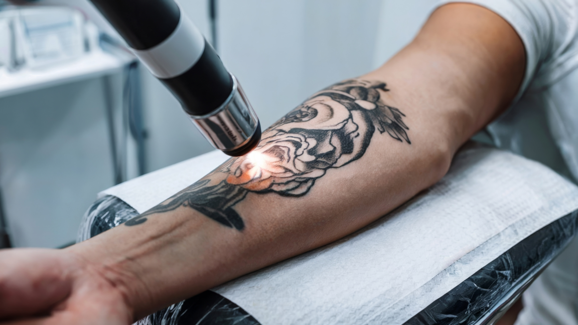 Tattoo Removal in Hollidaysburg, PA