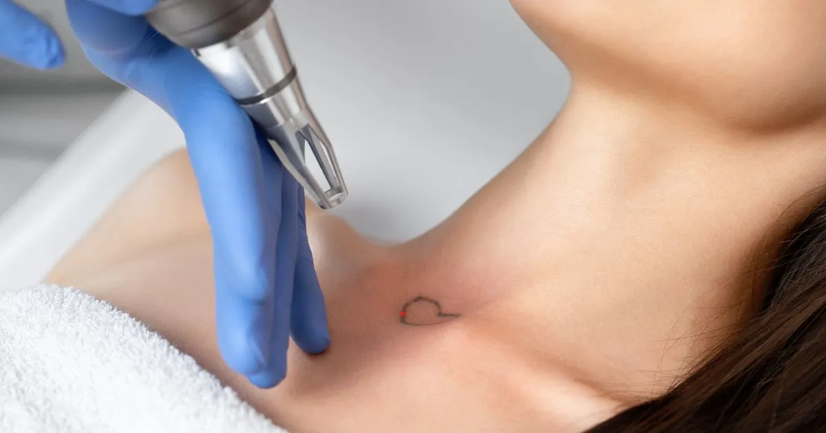 Close-up of a patient receiving laser tattoo removal near the eye, emphasizing the precision and safety of the procedure with eye protection